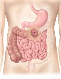 Colostomia transversa