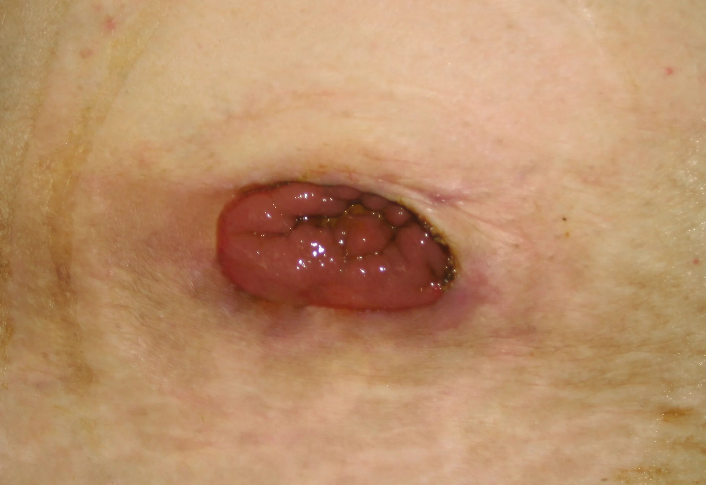 A Flush Stoma with no border