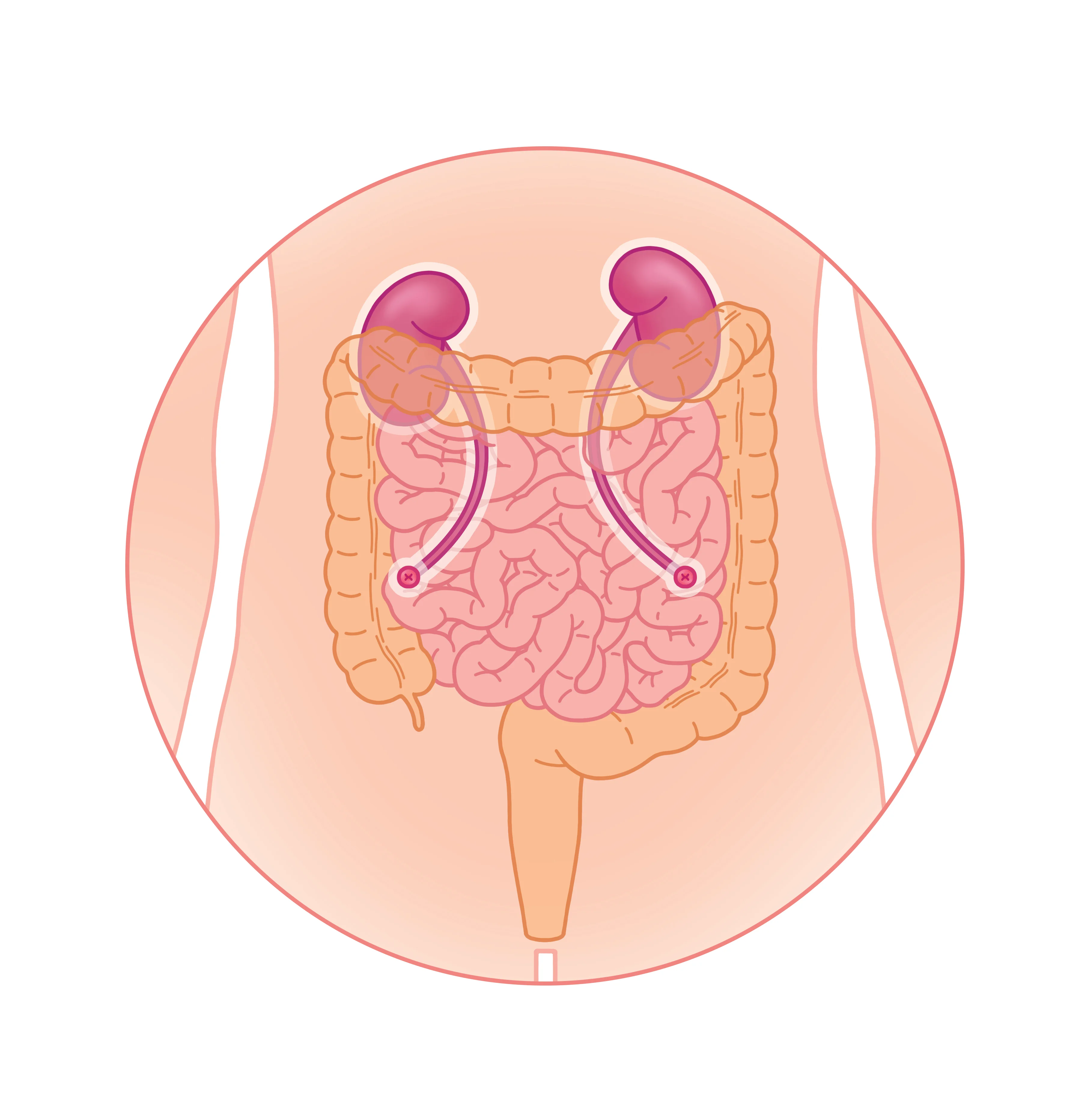 Ureterostomies cutanées directes